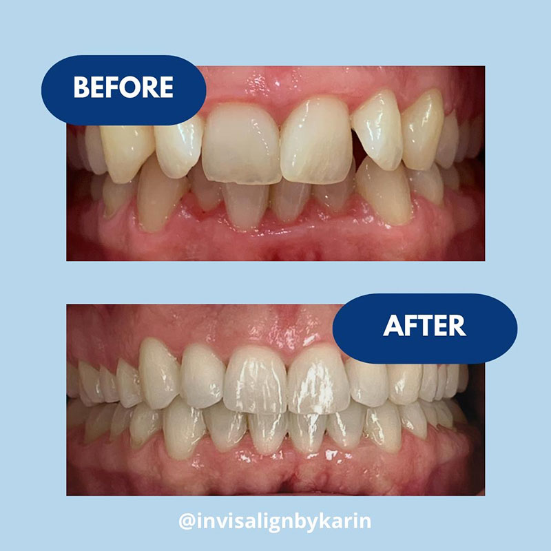 Invisalign Karin
