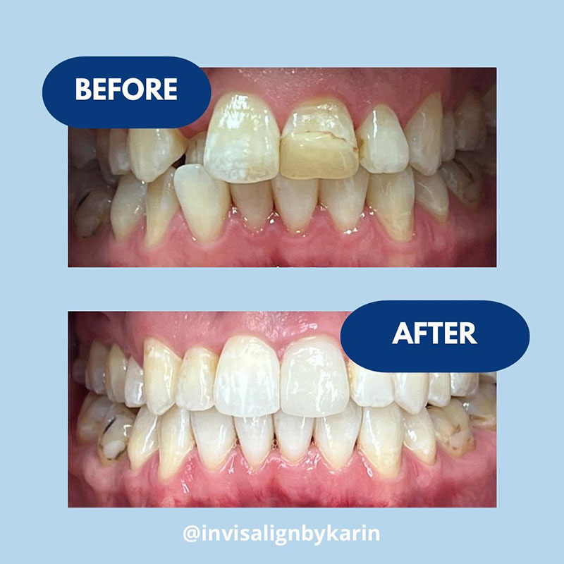 Invisalign Karin