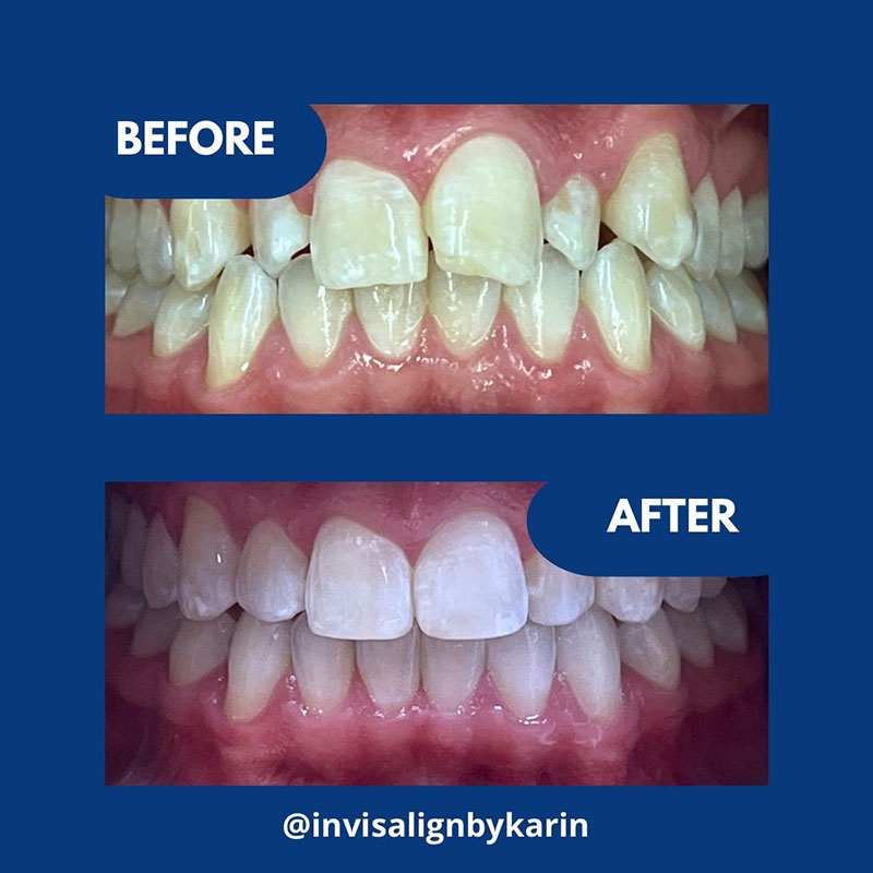 Invisalign Karin